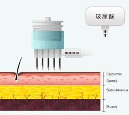 水光针多久一次(水光针可以10天打一次吗)