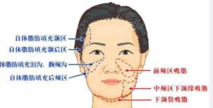 面部吸脂多久恢复(做面部拉皮的最佳年龄)