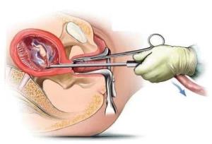 怀孕多久可以刮宫(清宫手术多少天做合适)