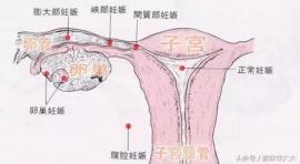 宫外孕手术住院多久(宫外孕吃药杀胚需要住院几天)